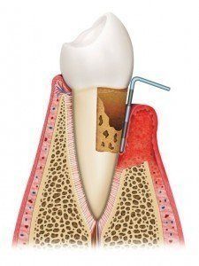 Cut away of a tooth and gums to show how gum disease affects the tooth. 